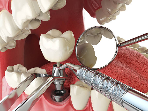 Best Emergency Dentist for Knocked-Out Tooth in Haviland, NY